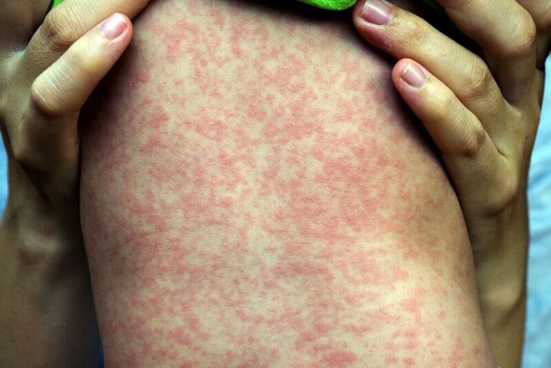 NEWS: Measles case reported at Kaneland – Should we be worried?